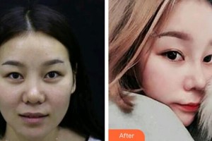 武警廣西總隊醫(yī)院醫(yī)學整形美容中心孫周映整形價格表附鼻部綜合案例展示