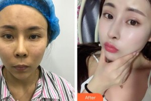 武警廣西總隊醫(yī)院醫(yī)學整形美容中心陳笑整形價格表附鼻修復案例展示