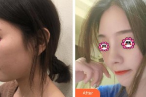 武警廣西總隊醫(yī)院醫(yī)學整形美容中心尹熙根整形價格表附肋軟骨隆鼻案例展示