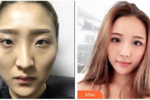 武警廣西總隊醫(yī)院醫(yī)學整形美容中心樸宰久整形價格表附假體隆鼻案例展示