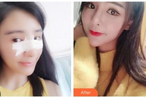 武警廣西總隊醫(yī)院醫(yī)學整形美容中心玉寶光 整形價格表附耳軟骨復合隆鼻案例展示