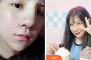 廣西民族醫(yī)院醫(yī)學美容科楊竟忠整形價格表附鼻部綜合案例展示