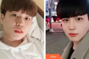 廣西中醫(yī)院第一附屬醫(yī)院美膚激光整形美容科韋文朗整形價格表附鼻部綜合案例展示