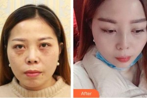 廣西東方整形美容醫(yī)院周憶芬整形價格表附鼻部綜合案例展示