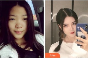 廣西中醫(yī)院第一附屬醫(yī)院美膚激光整形美容科梁桂枝整形價格表附鼻部綜合案例展示