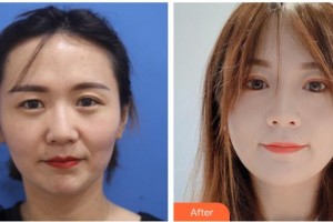 武警廣西總隊醫(yī)院醫(yī)學(xué)整形美容中心趙元整形價格表附埋線雙眼皮案例展示