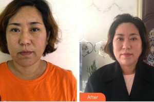 廣西中醫(yī)藥大學(xué)附屬瑞康醫(yī)院整形美容中心李莉整形價格表附切開雙眼皮案例展示