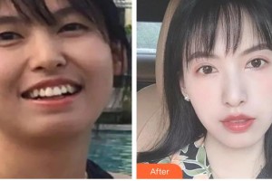 廣西中醫(yī)藥大學(xué)附屬瑞康醫(yī)院整形美容中心吳偉民整形價格表附金屬托槽矯正案例展示