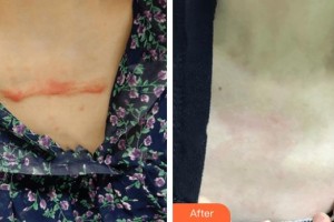 廣西科技大學(xué)第一附屬醫(yī)院骨傷整形科韋元強整形價格表附微創(chuàng)疤痕修復(fù)案例展示