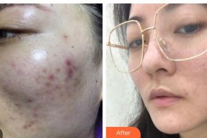 廣西東方整形美容醫(yī)院楊競忠整形價格表附去痘印痘坑案例展示