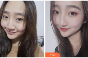 廣西醫(yī)科大學(xué)第一附屬醫(yī)院整形美容科梁自乾整形價格表附激光祛斑案例展示