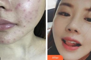 武警廣西總隊醫(yī)院醫(yī)學(xué)整形美容中心董小飛整形價格表附紅藍光祛痘案例展示