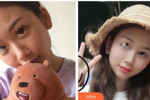 廣西東方整形美容醫(yī)院陳柳藝整形價格表附清潔祛痘案例展示