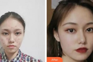 廣西愛思特整形外科醫(yī)院趙彩明整形價格表附紅藍光祛痘案例展示