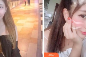 廣西東方整形美容醫(yī)院龍海波整形價格表附彩光嫩膚案例展示