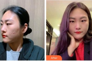 廣西醫(yī)科大學(xué)第一附屬醫(yī)院整形美容科蒙誠躍整形價格表附清潔祛痘案例展示