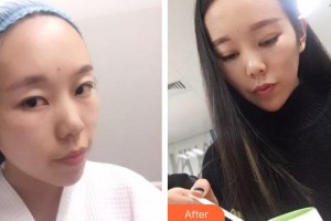 廣西來賓愛爾眼科醫(yī)院伍偉峰整形價格表附眼部綜合案例展示