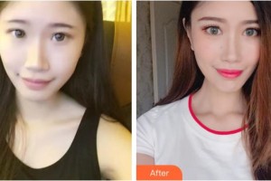 柳州愛爾眼科醫(yī)院蔣春秀整形價格表附切開雙眼皮案例展示