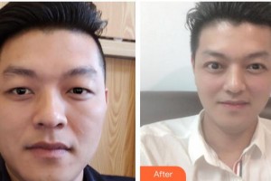 柳州愛爾眼科醫(yī)院陳振文整形價格表附切開雙眼皮案例展示