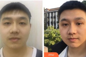 柳州紅十字會眼科醫(yī)院王歡燕整形價格表附切開雙眼皮案例展示