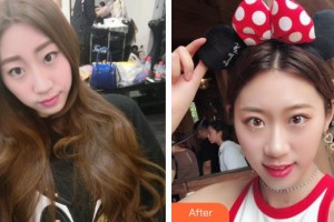 柳州市柳鐵中心醫(yī)院燒傷整形外科龍昕整形價格表附切開雙眼皮案例展示