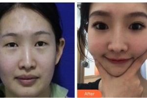 柳州市人民醫(yī)院眼科陶耘整形價格表附定點雙眼皮案例展示