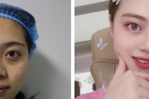 柳州市中醫(yī)醫(yī)院眼科唐柳蘋整形價格表附激光去眼袋案例展示