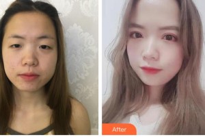 桂林醫(yī)學(xué)院第二附屬醫(yī)院眼科黃雪英整形價格表附切開雙眼皮案例展示