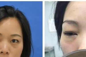 桂林市人民醫(yī)院眼科蔡濤整形價(jià)格表附眼部綜合案例展示