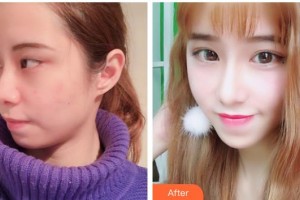 桂林市人民醫(yī)院眼科伍雪云整形價格表附眼部綜合案例展示