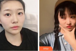 梧州市工人醫(yī)院眼科李沂鋼整形價(jià)格表附激光去眼袋案例展示