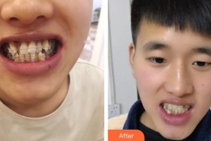 梧州華美整形美容醫(yī)院孔華鋒整形價(jià)格表附隱形托槽矯正案例展示