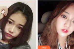 北海韓美醫(yī)療美容門診部劉秀艷整形價(jià)格表附眼部綜合案例展示