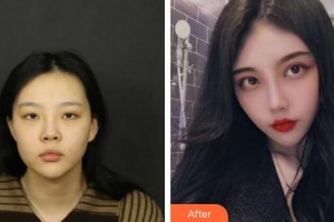 北海韓美醫(yī)療美容門診部楊雙輝整形價格表附埋線雙眼皮案例展示