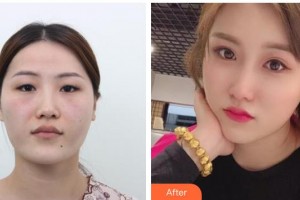 北海博鏵醫(yī)院整形美容中心余德慶整形價格表附切開雙眼皮案例展示