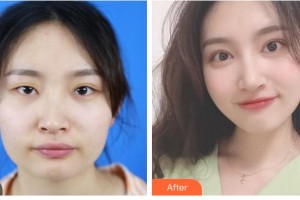 欽州市第二人民醫(yī)院眼科余業(yè)明整形價(jià)格表附眼部綜合案例展示