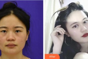 貴港市人民醫(yī)院燒傷整形外科黃運(yùn)嚴(yán)整形價(jià)格表附切開雙眼皮案例展示