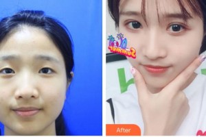 貴港愛爾眼科醫(yī)院吳香蓮整形價(jià)格表附眼部綜合案例展示