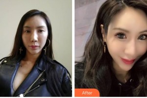 貴港愛爾眼科醫(yī)院黃瓊整形價(jià)格表附切開雙眼皮案例展示