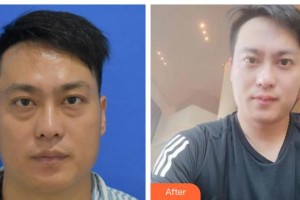 貴港愛爾眼科醫(yī)院胡美霞整形價(jià)格表附激光去眼袋案例展示