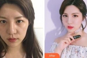 玉林愛爾眼科醫(yī)院盧榮強(qiáng)整形價(jià)格表附眼部修復(fù)案例展示