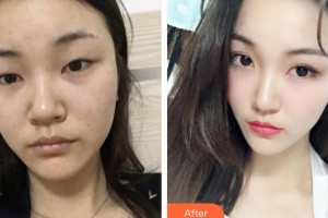 玉林愛爾眼科醫(yī)院王碧華整形價(jià)格表附眼部綜合案例展示