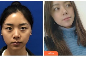 玉林時(shí)光醫(yī)療美容醫(yī)院李紅梅整形價(jià)格表附定點(diǎn)雙眼皮案例展示