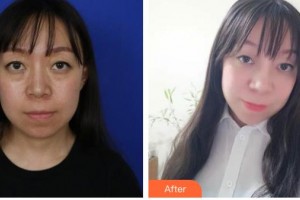 玉林愛爾眼科醫(yī)院黃玫整形價(jià)格表附外切祛眼袋案例展示