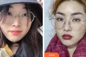 河池市中醫(yī)醫(yī)院眼科黃炳護(hù)整形價(jià)格表附眼部綜合案例展示