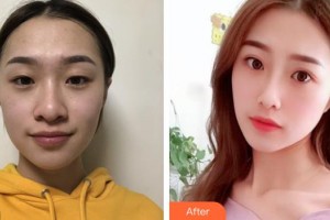 河池市中醫(yī)醫(yī)院眼科韋付林整形價(jià)格表附切開雙眼皮案例展示