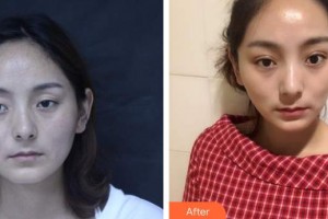 來賓市人民醫(yī)院眼科吳佳勢整形價(jià)格表附切開雙眼皮案例展示