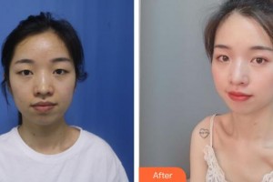 來賓市人民醫(yī)院眼科黃平整形價(jià)格表附定點(diǎn)雙眼皮案例展示