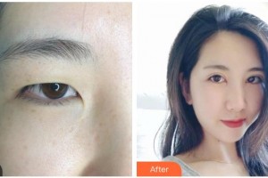 來賓市人民醫(yī)院眼科李榮成整形價(jià)格表附定點(diǎn)雙眼皮案例展示