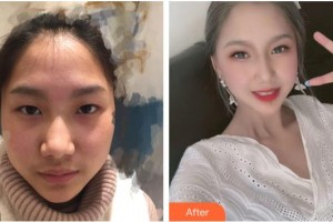 來賓市人民醫(yī)院眼科韋曉星整形價(jià)格表附眼部綜合案例展示